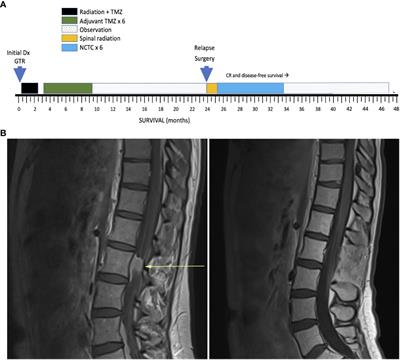 Network-targeting combination therapy of leptomeningeal glioblastoma using multiple synthetic lethal strategies: a case report